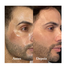 Load image into Gallery viewer, Facial Peeling + Vitamin C for MELASMA by Agustin Fernandez
